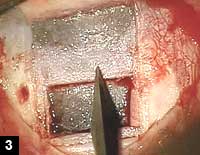 Figure 3: Paracentesis with a 20-gauge stab anterior to the deep sclerectomy