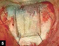 Figure 5: The superficial scleral flap is secured