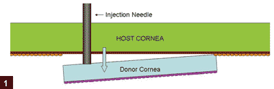 Figure 1: Normal cannula can push the donor tissue away from the host cornea during aspiration of the interface fluid