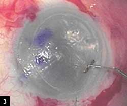 Figure 3: Image captured from surgical video