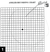 Figure 1: Amsler grid test