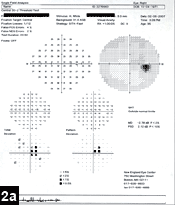 Figure 2a: Humphrey SITA standard 24-2 threshold automated perimetry