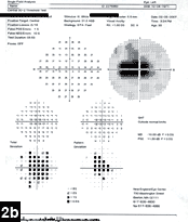 Figure 2b: Humphrey SITA standard 24-2 threshold automated perimetry