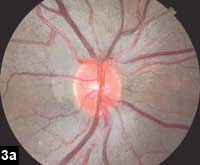 Figure 3a: Color fundus photo