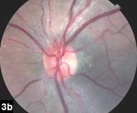 Figure 3b: Color fundus photo