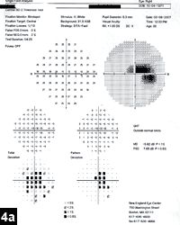 Figure 4a: Humphrey SITA standard 24-2 threshold automated perimetry