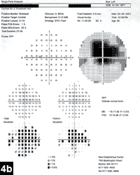 Figure 4b: Humphrey SITA standard 24-2 threshold automated perimetry