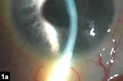 Figure 1a: The keratic precipitates inferiorly and the mottled corneal light reflex indicating the presence of edema