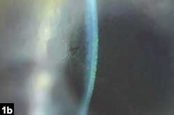 Figure 1b: The keratic precipitates inferiorly and the mottled corneal light reflex indicating the presence of edema