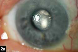 Figure 2a: Band of keratic precipitates extending from the limbus to the central cornea