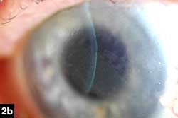 Figure 2b: Band of keratic precipitates extending from the limbus to the central cornea