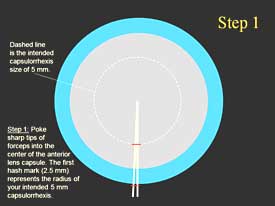 Step-by-step technique for capsulorrhexis: Step 1