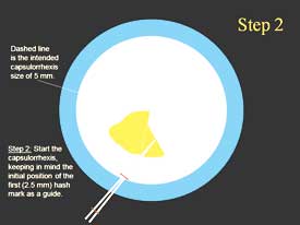 Step-by-step technique for capsulorrhexis: Step 2