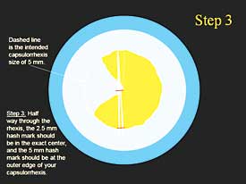 Step-by-step technique for capsulorrhexis: Step 3