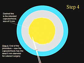 Step-by-step technique for capsulorrhexis: Step 4