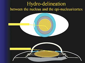 Hydro-delineation between the nucleus and the epi-nucleus/cortex