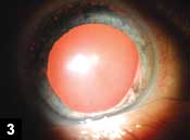 Figure 3. Inferonasal sectoral iris atrophy of the right eye