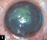 Figure 1: Preoperative clinical picture showing anterior stromal opacities with lattice lines and diffuse stromal haze