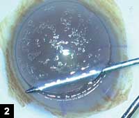 Figure 2: Donor corneal tissue dissected with the Intra-Lase laser 