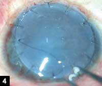 Figure 4: Donor tissue placed over recipient bed and sutured with interrupted sutures