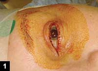 Figure 1: Ocular surface and eyelids disinfected before surgery