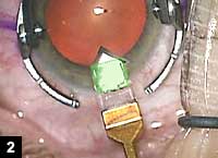 Figure 2: Square corneal incision