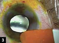 Figure 3:  Fluorescein strip used to perform a Seidel test to check the incisions for leakage