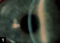 Figure 1: Diffuse corneal edema in the right eye