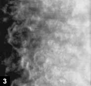 Figure 3: Hexagonal endothelial cells with  pleomorphism and polymegethism