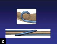 Figure 2: The ring grasps the iris at equidistant points