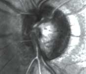 A patient's glaucomatous progression is followed using HRT