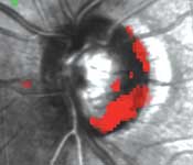 A patient's glaucomatous progression is followed using HRT