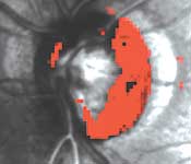 A patient's glaucomatous progression is followed using HRT