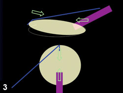 Figure 3: The nucleus can be tilted out of the capsular bag