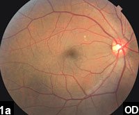 Figure 1a: Color fundus photograph of the eye