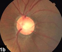 Figure 1b: Close up of the left optic nerve head.