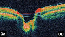 Figure 3a: Optical coherence tomography