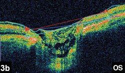 Figure 3b: Optical coherence tomography