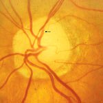 Localized constrictions of retinal arteries 