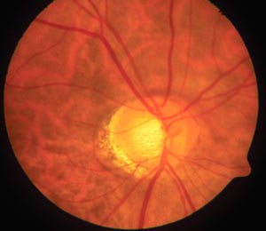 Studies in vasospastic patients and nonvasospastic patients highlight that blood flow in the neuroretinal rim is more sensitive to changes in IOP in vasospastic patients.