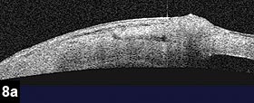 Figure 8a: Anterior segment OCT of scleral flap