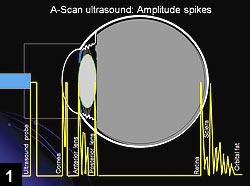 Figure 1: The five primary amplitude spikes in A-scan ultrasound