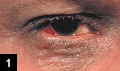 Figure 1: The patient has dry, scaly lids with hyperpigmentation