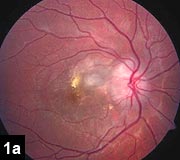 Figure 8a: Anterior segment OCT of scleral flap