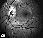 Figure 2a: Nodules on the disc correspond to areas of autofluorescence on the red free photos