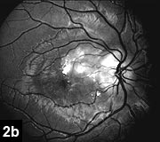 Figure 2b: Nodules on the disc correspond to areas of autofluorescence on the red free photos