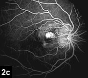 Figure 2c: Nodules on the disc correspond to areas of autofluorescence on the red free photos