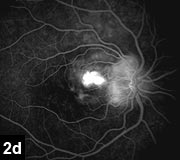 Figure 2d: Nodules on the disc correspond to areas of autofluorescence on the red free photos