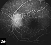 Figure 2e: Nodules on the disc correspond to areas of autofluorescence on the red free photos