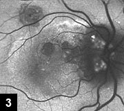 Figure 3: One year after submacular surgery